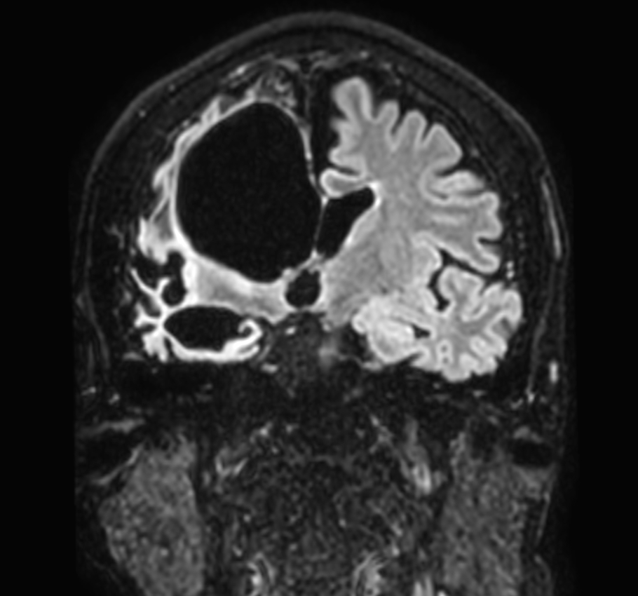 Coronal 3D BrainVIEW FLAIR (without Compressed SENSE)