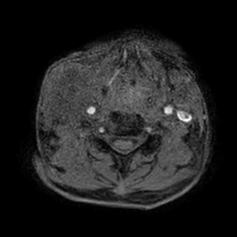 Axial T1w mDIXON XD - pre-gado