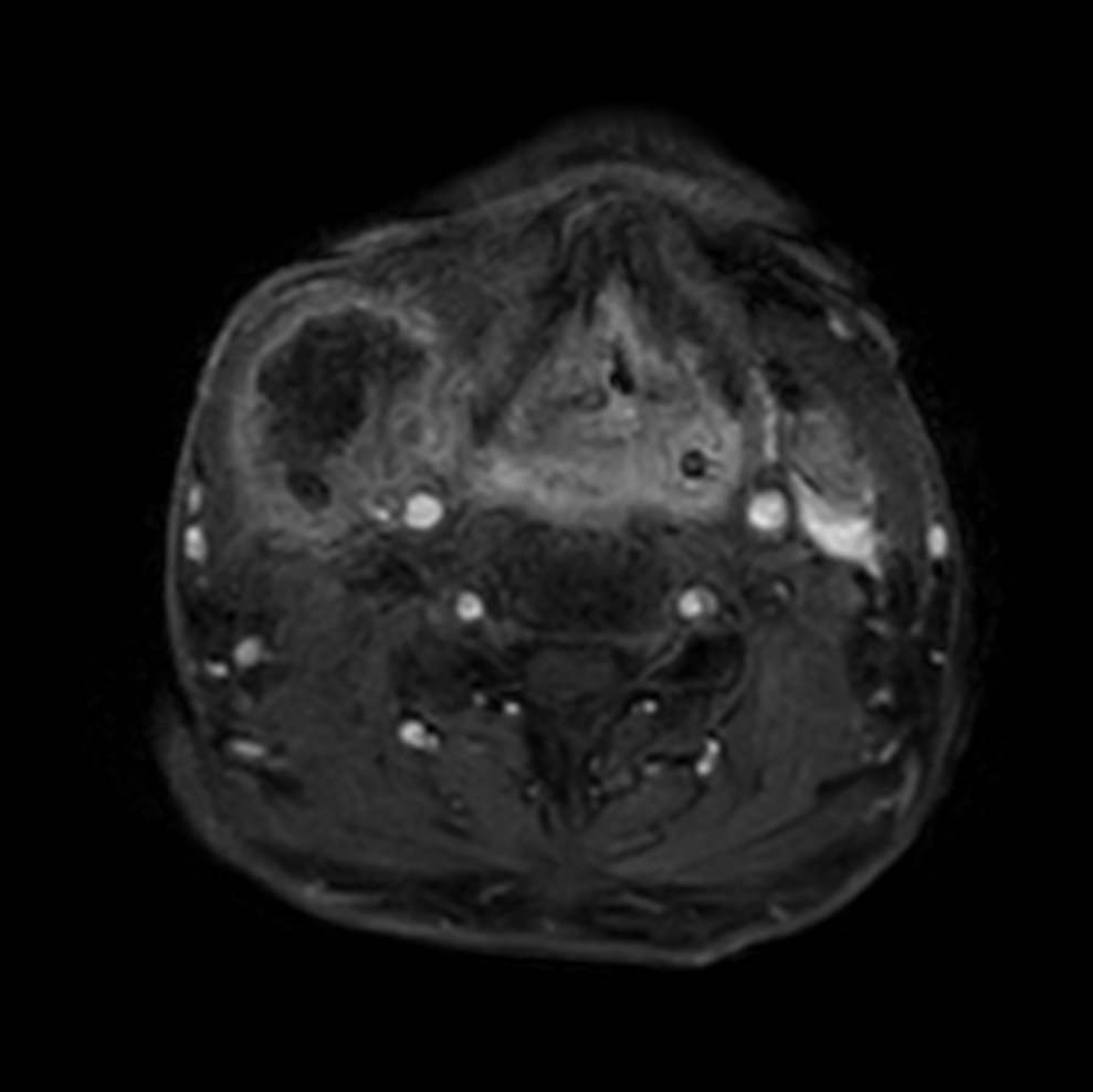 Axial T1w mDIXON XD - post-gado (dyn 1)
