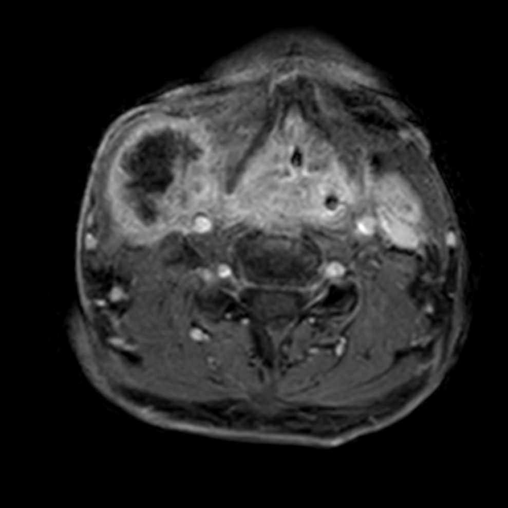 Axial T1w mDIXON XD - post-gado (dyn 6)