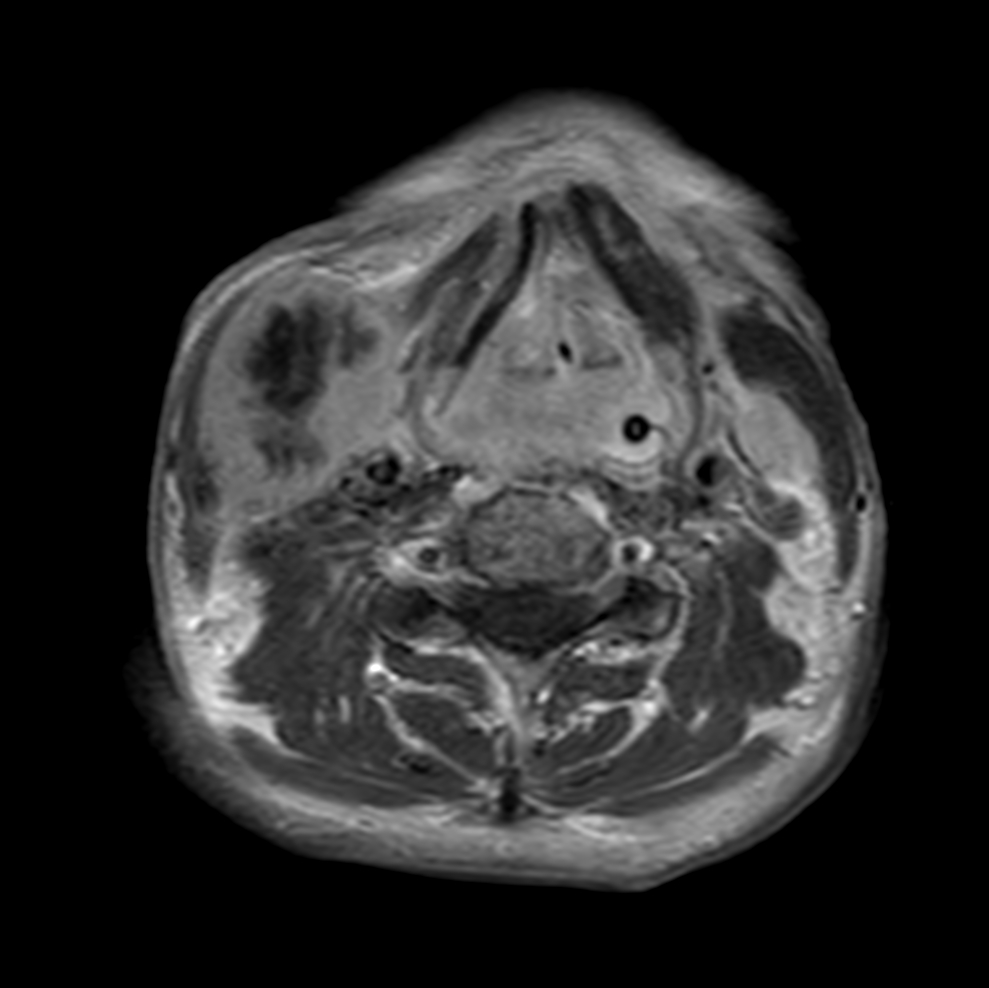 Axial T1w TSE post-gado
