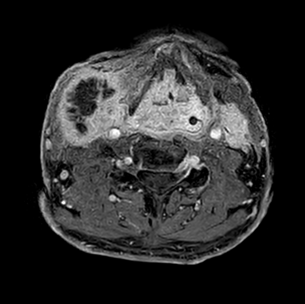 Axial T1w mDIXON XD - post-gado 