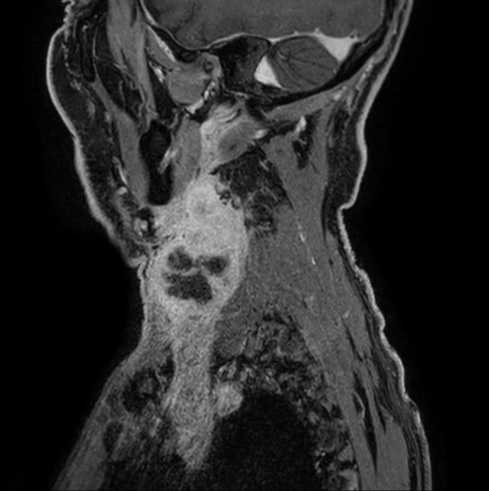 Sagittal T1w mDIXON XD - post-gado 