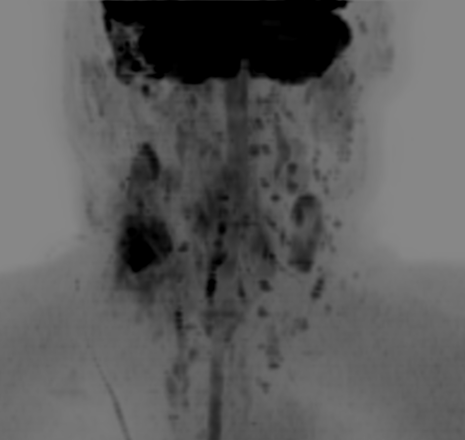 DWIBS (b700) - Coronal MIP