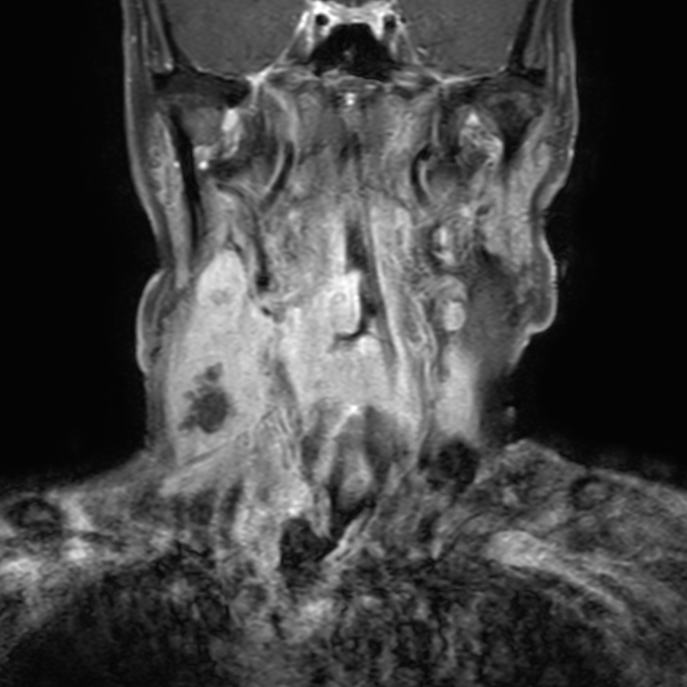 Coronal T1w FatSat post-gado