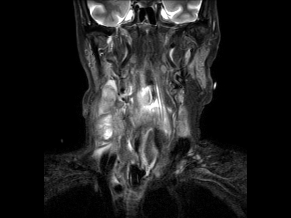 Coronal STIR TSE