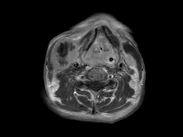 Axial T1w TSE post-gado