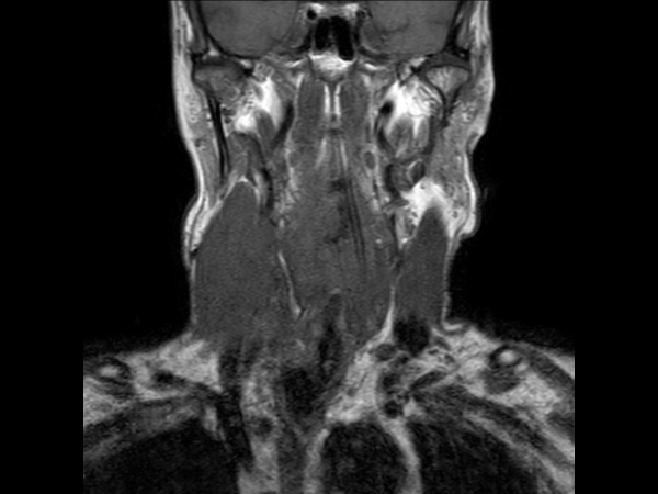 Coronal T1w TSE