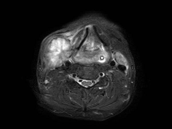 Axial STIR TSE