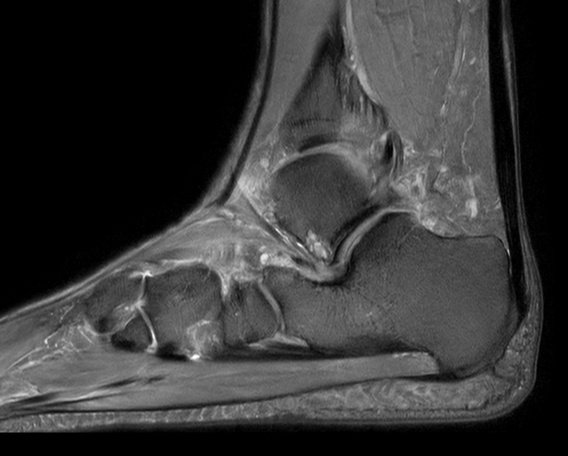 Sagittal PDw TSE mDIXON XD (Partial FatSat)
