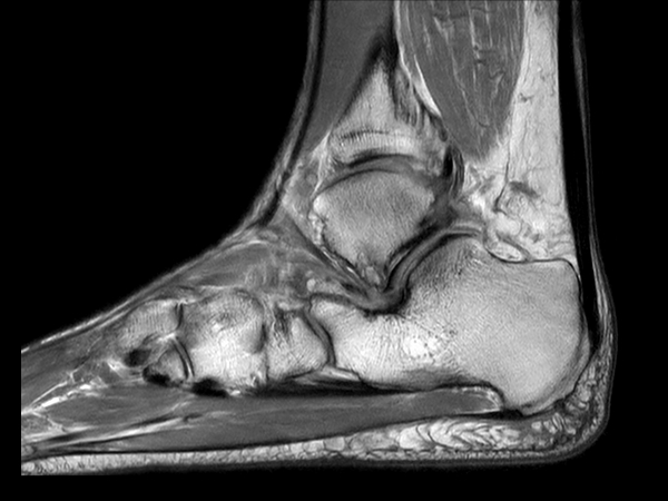 Sagittal PDw TSE mDIXON XD (In Phase)