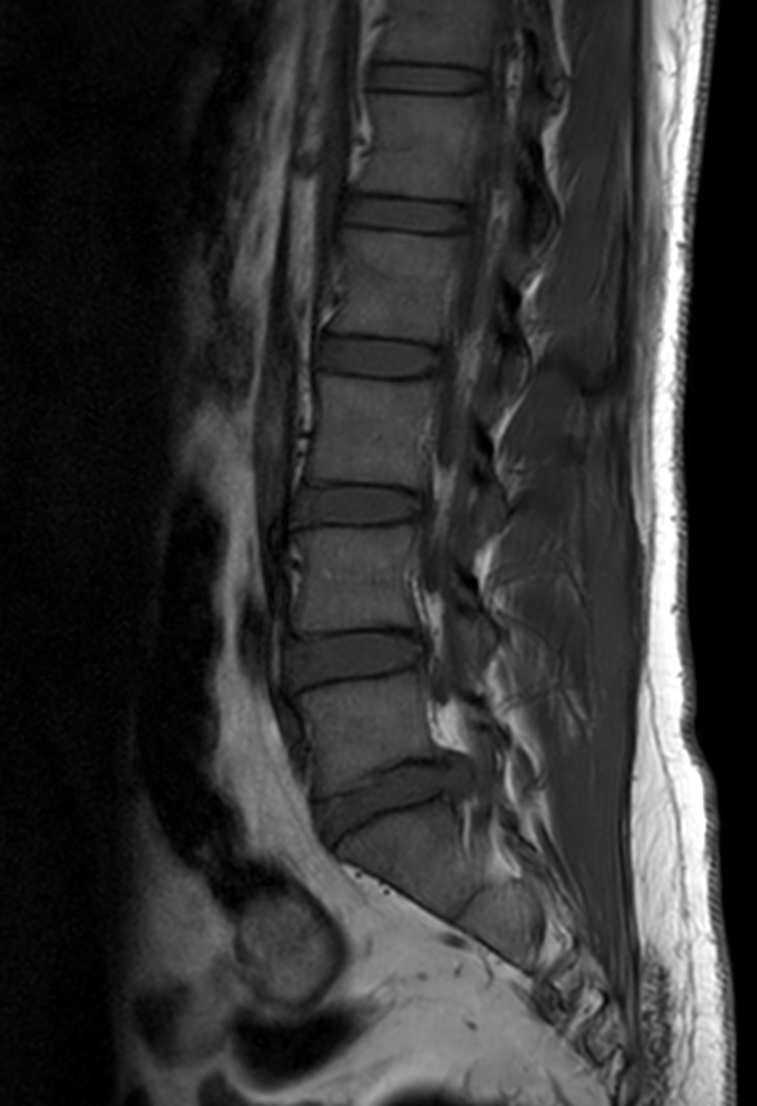 Sagittal T1w TSE