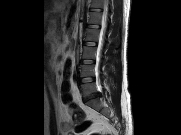 Sagittal T2w TSE 