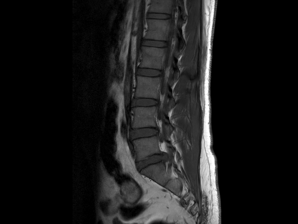 Sagittal T1w TSE