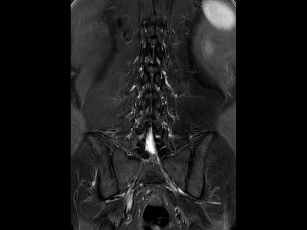 Coronal STIR TSE