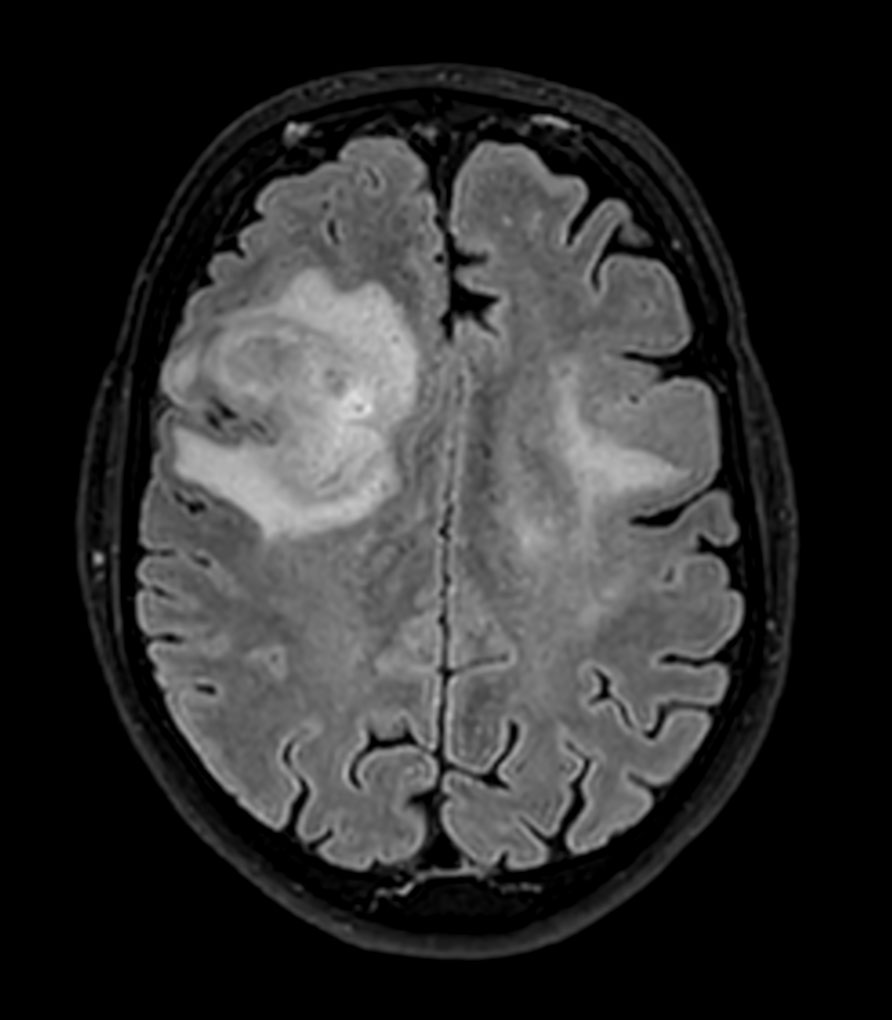 Axial 3D BrainVIEW FLAIR