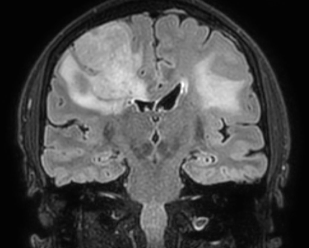 3D BrainVIEW FLAIR (coronal reformat)