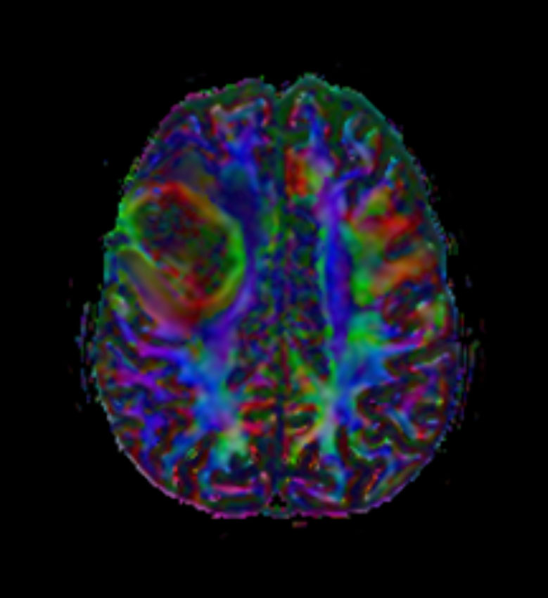 Axial DTI FiberTrak (FA)