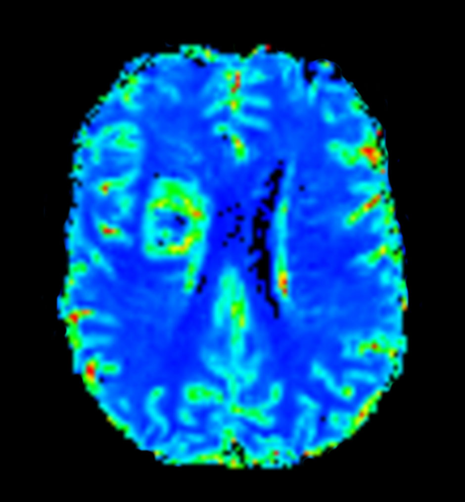 Axial T2* Perfusion (Index)