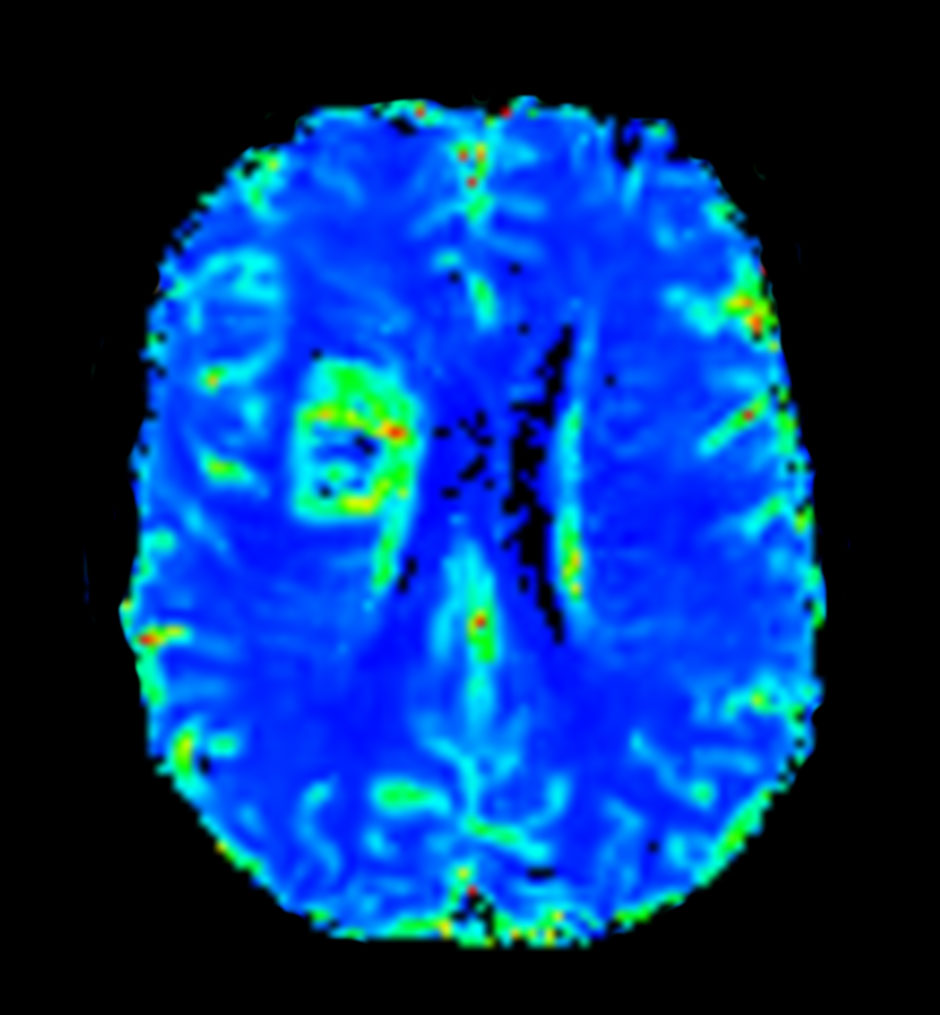 Axial T2* Perfusion (NI)