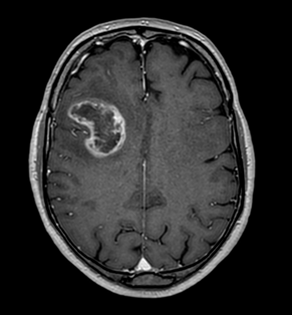 Axial 3D T1w TFE with gado