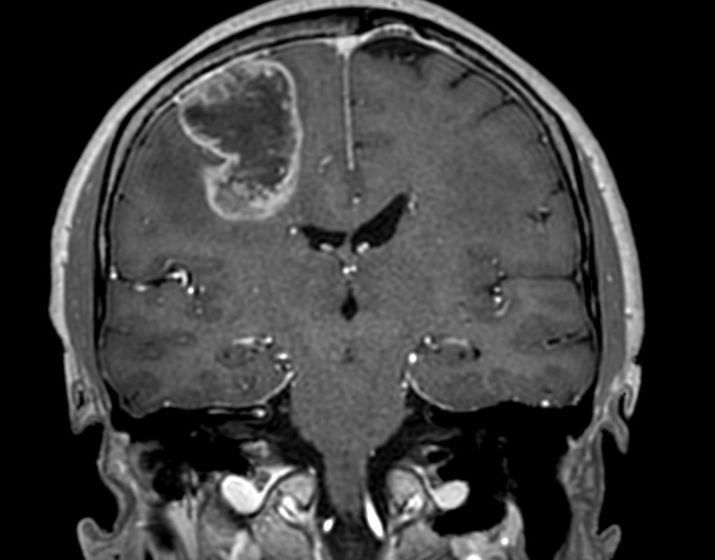 3D T1w TFE with gado (coronal reformat)