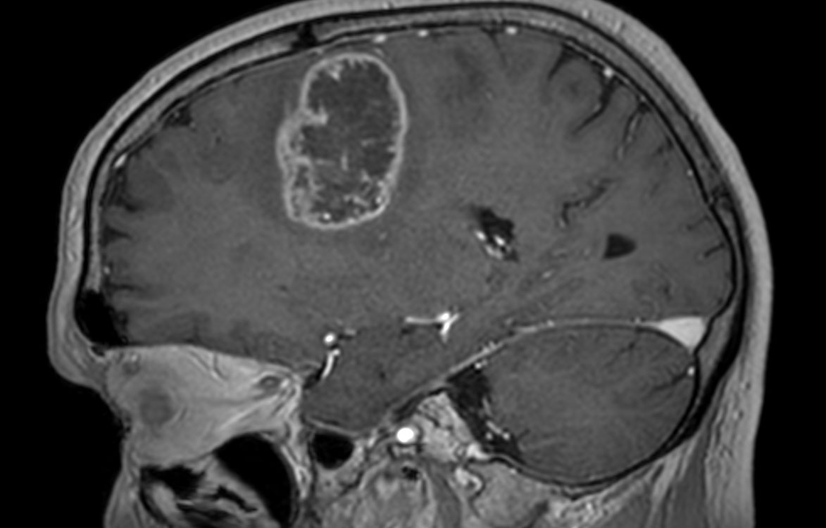 3D T1w TFE with gado (sagittal reformat)