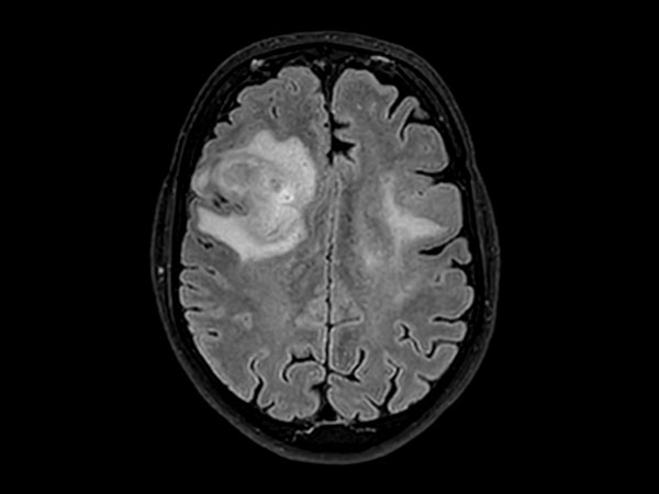 Axial 3D BrainVIEW FLAIR