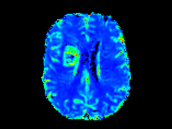 Axial T2* Perfusion (NI)