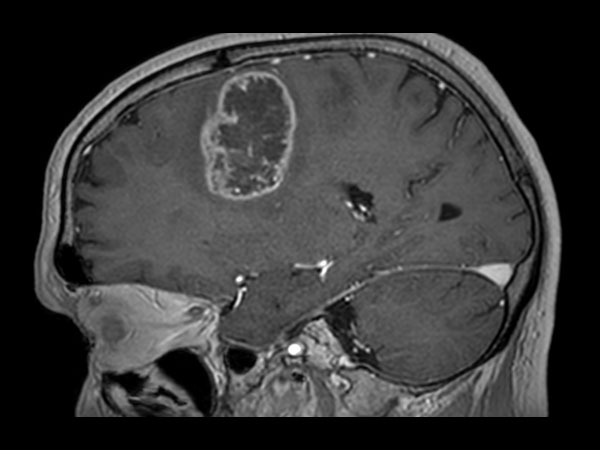 3D T1w TFE with gado (sagittal reformat)