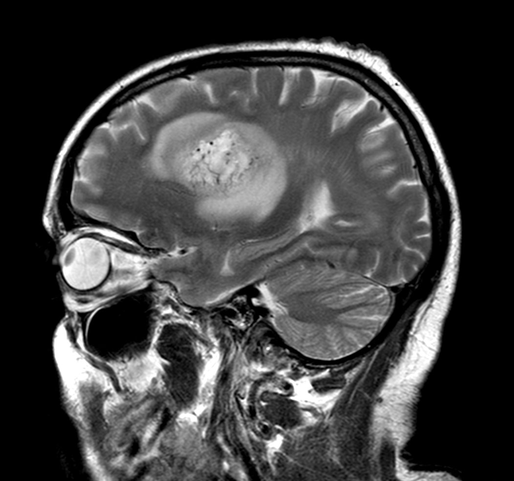 Sagittal T2w TSE
