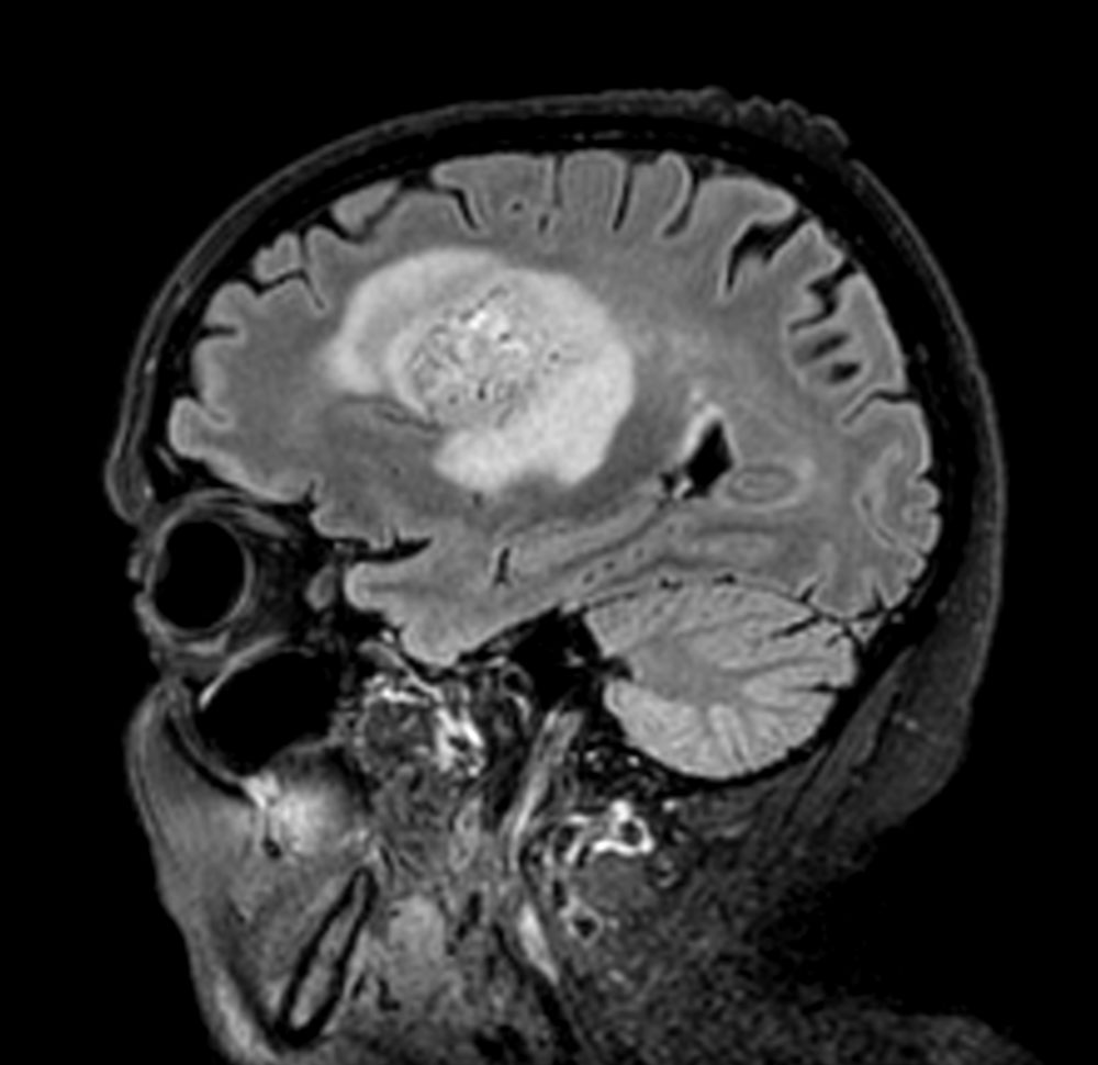 Sagittal 3D BrainVIEW FLAIR