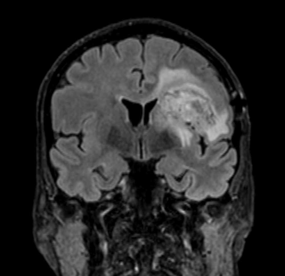 3D BrainVIEW FLAIR (coronal reformat)