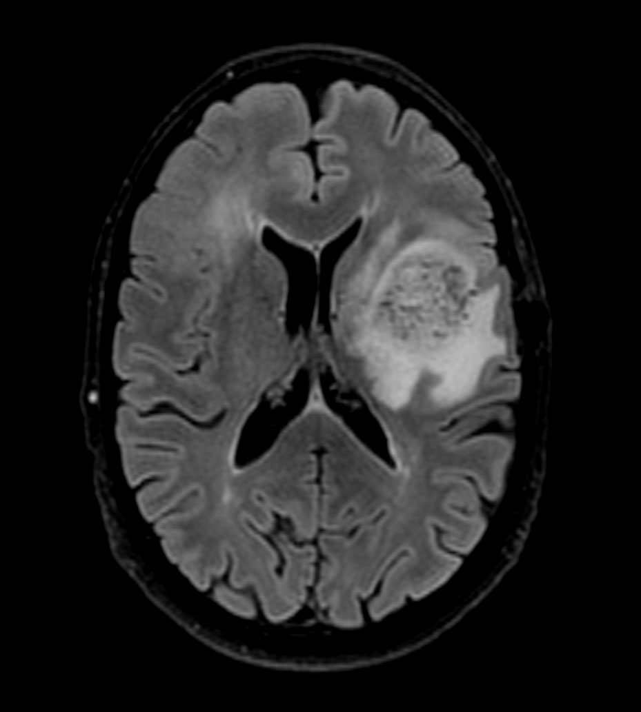 3D BrainVIEW FLAIR (axial reformat)