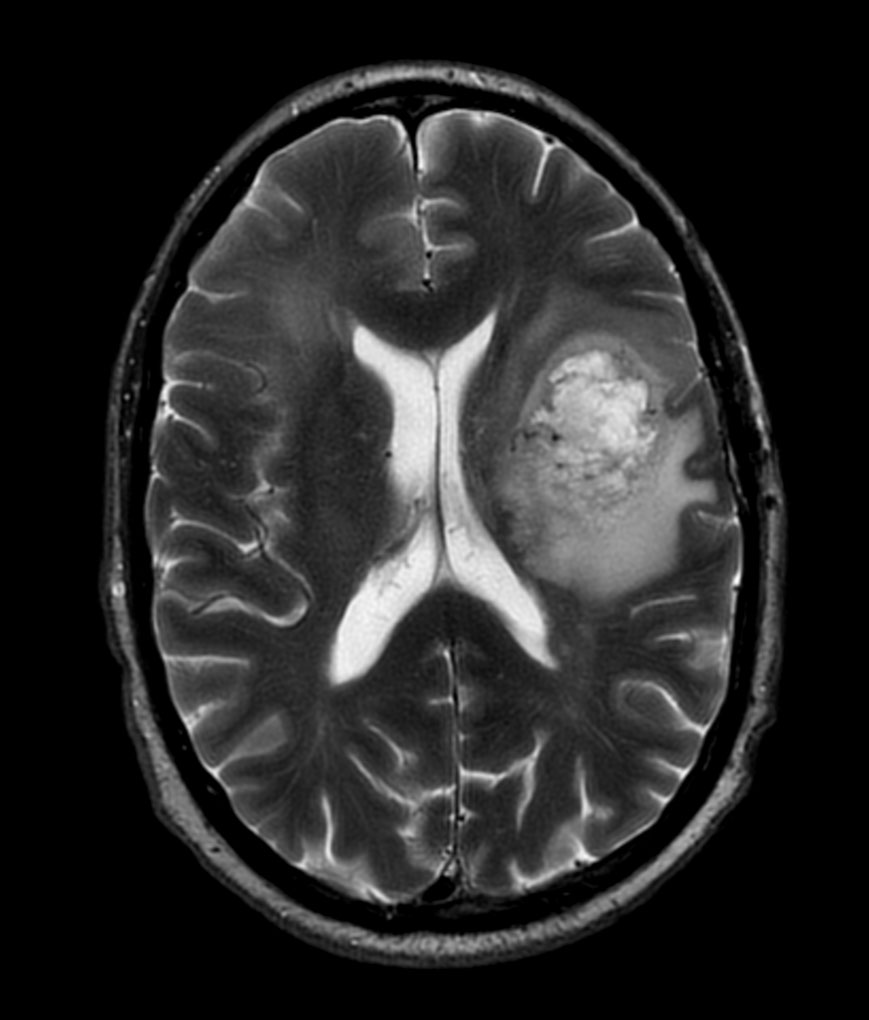 Axial T2w MultiVane XD