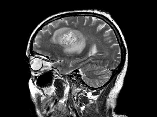 Sagittal T2w TSE