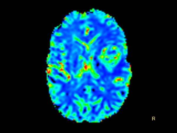 Axial T2* Perfusion (Index)