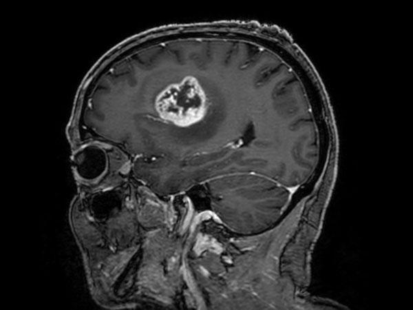 Sagittal T1w 3D TFE