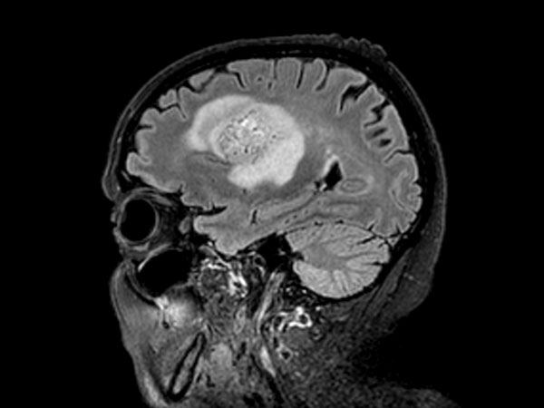 Sagittal 3D BrainVIEW FLAIR