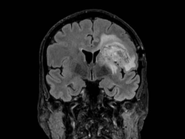 3D BrainVIEW FLAIR (coronal reformat)