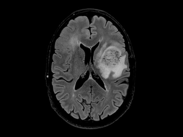 3D BrainVIEW FLAIR (axial reformat)