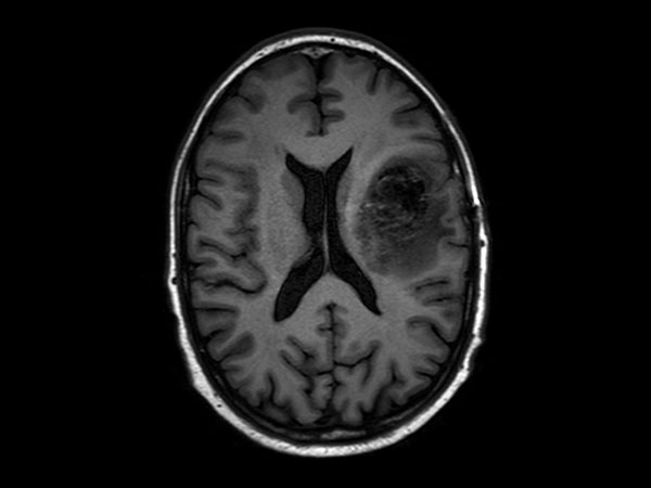 Axial T1w IR TSE