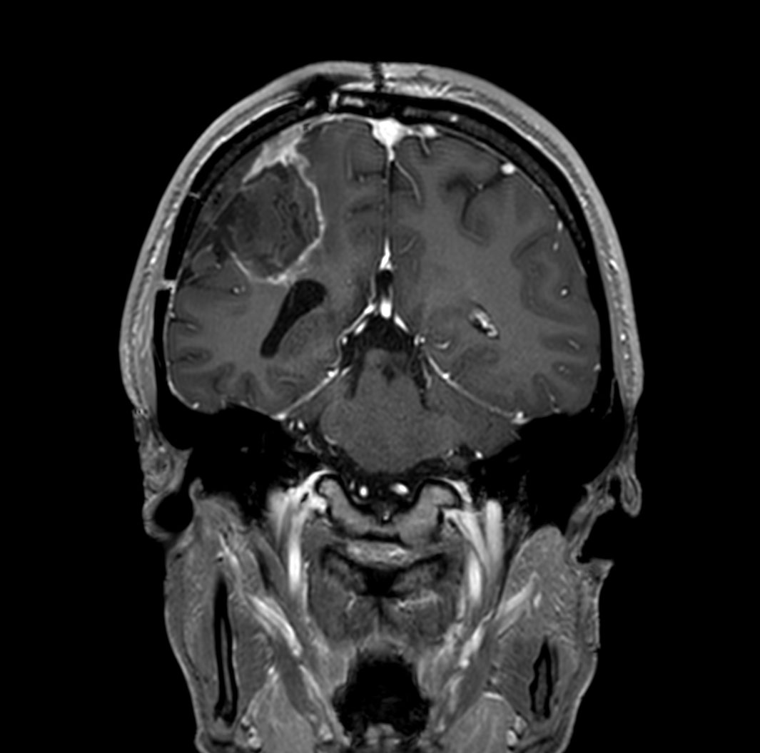 T1w 3D FFE with gado (coronal reformat)