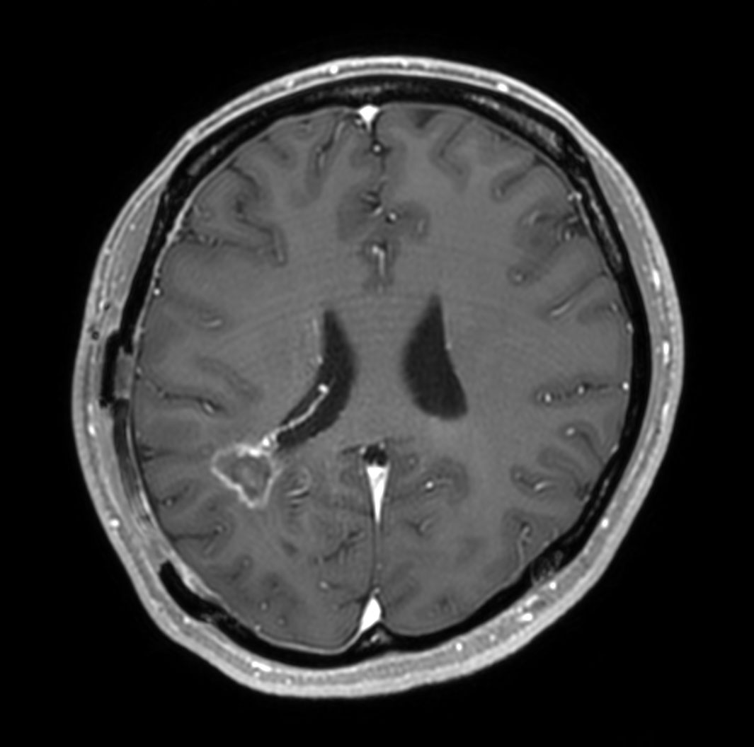 T1w 3D FFE with gado (axial reformat)