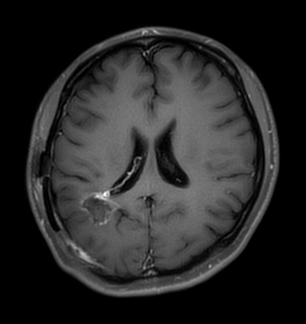 Axial T1w IR TSE with gado