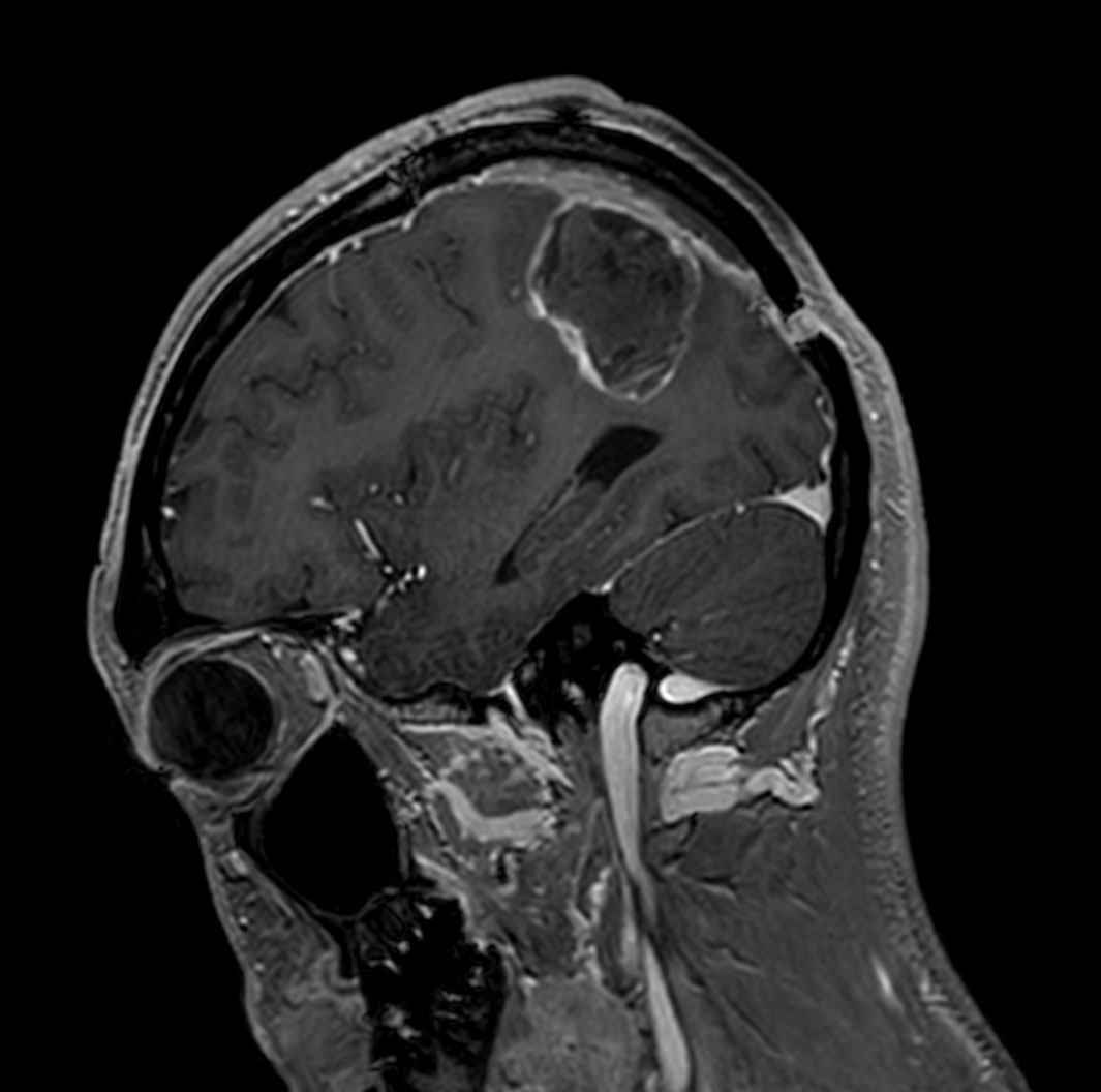 Sagittal T1w 3D FFE with gado
