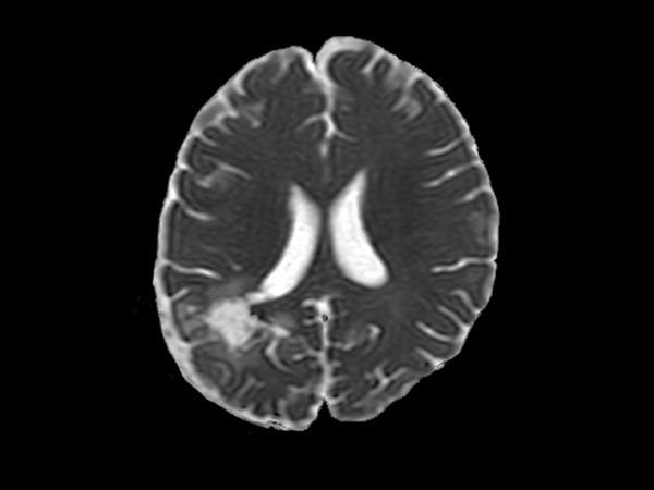 Axial DWI (ADC)