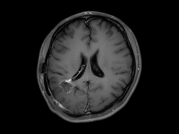 Axial T1w IR TSE with gado