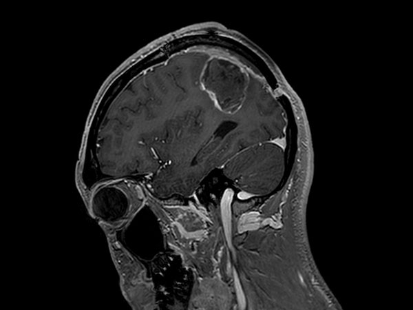 Sagittal T1w 3D FFE with gado