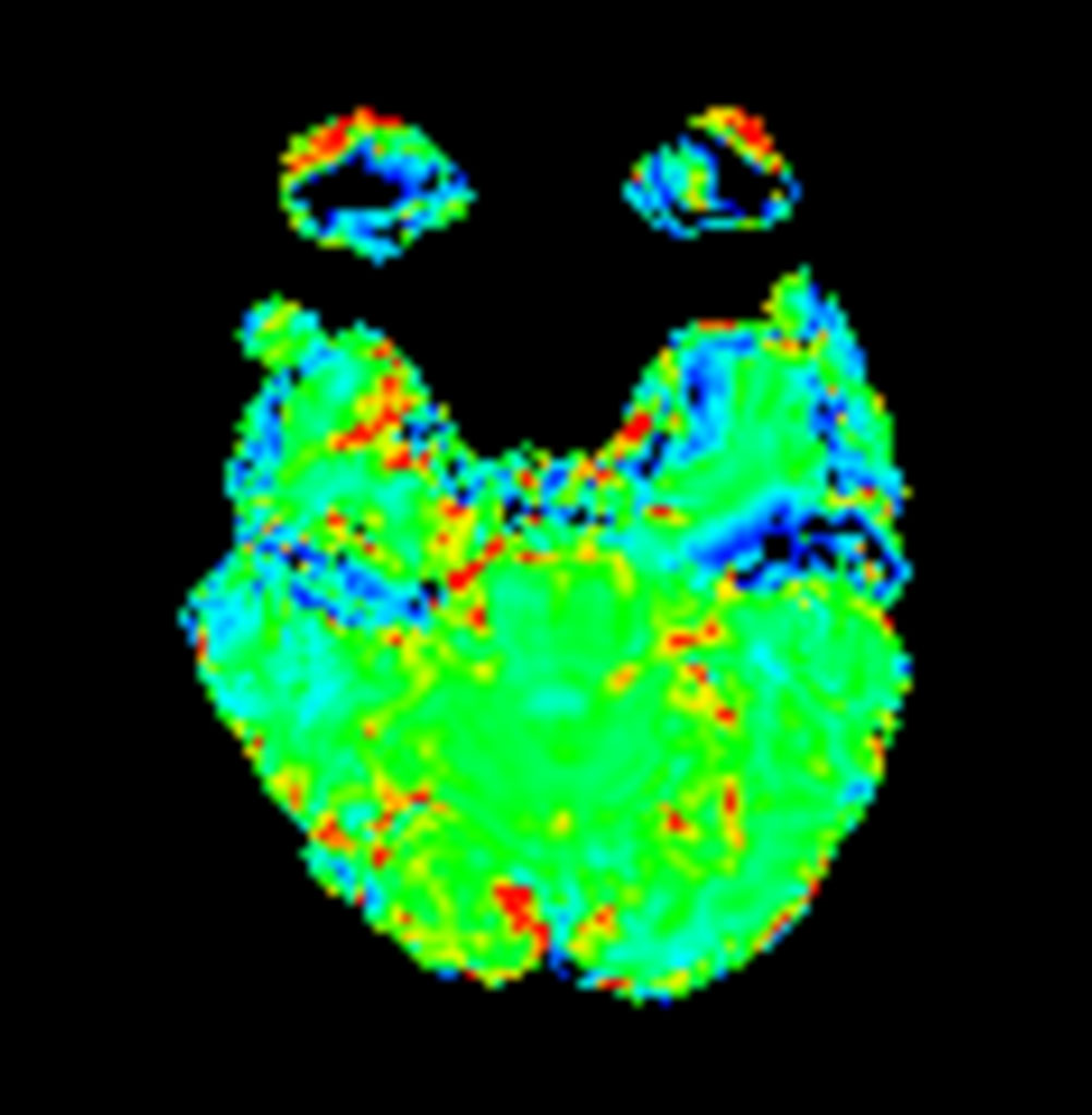Axial T2* Perfusion (Index)
